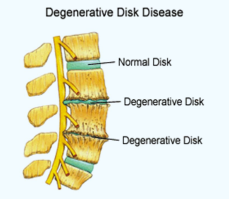 Degenerative Disk Disease