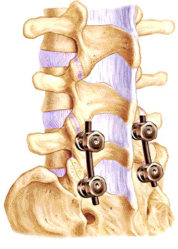 Posterior screws in spine