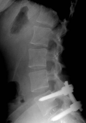 Posterior screws x ray
